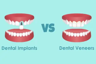 Dental implants vs veneers
