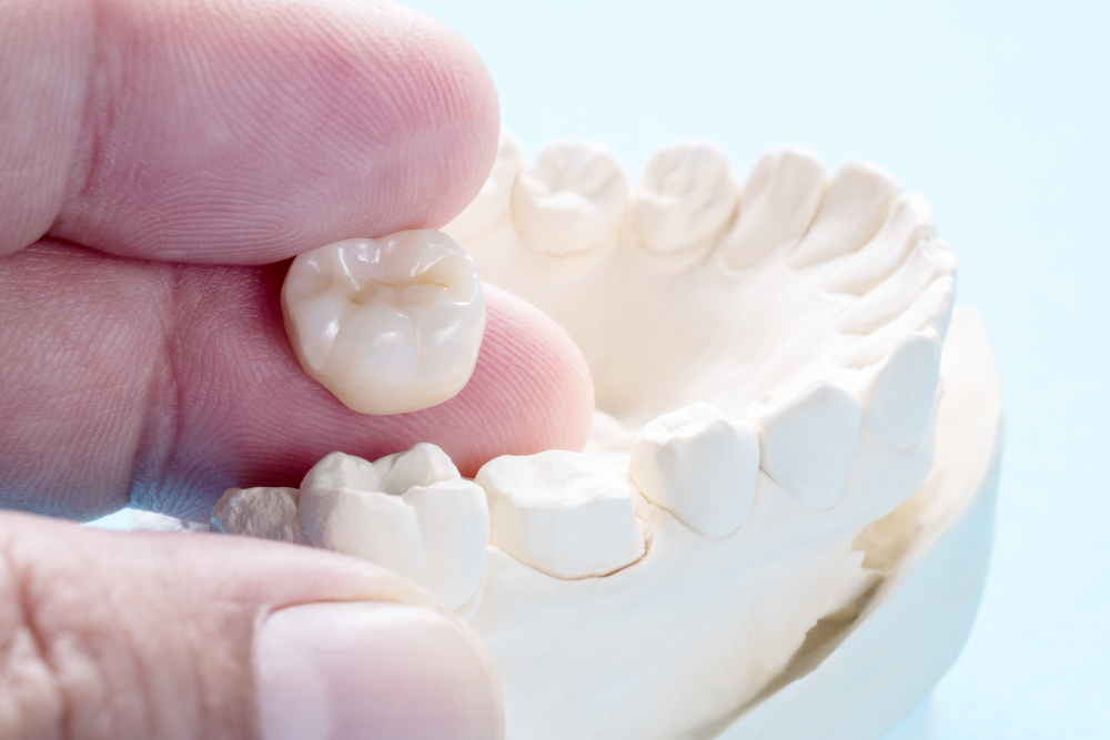 Close-up of a dental crown being placed on a tooth model