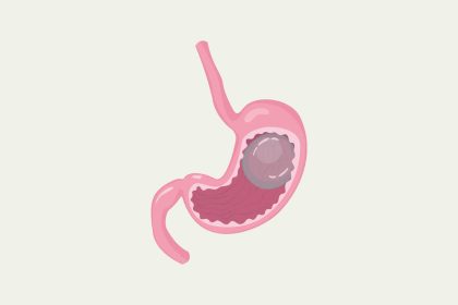 Medical illustration showing gastric balloon inside the stomach