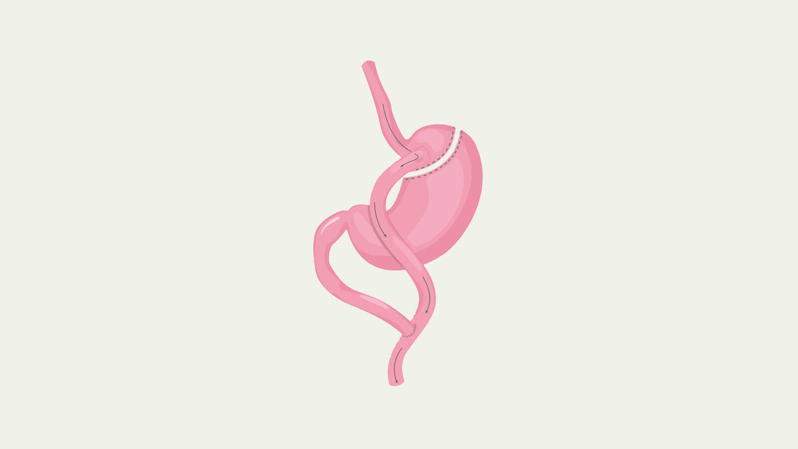Gastric bypass surgery stomach illustration