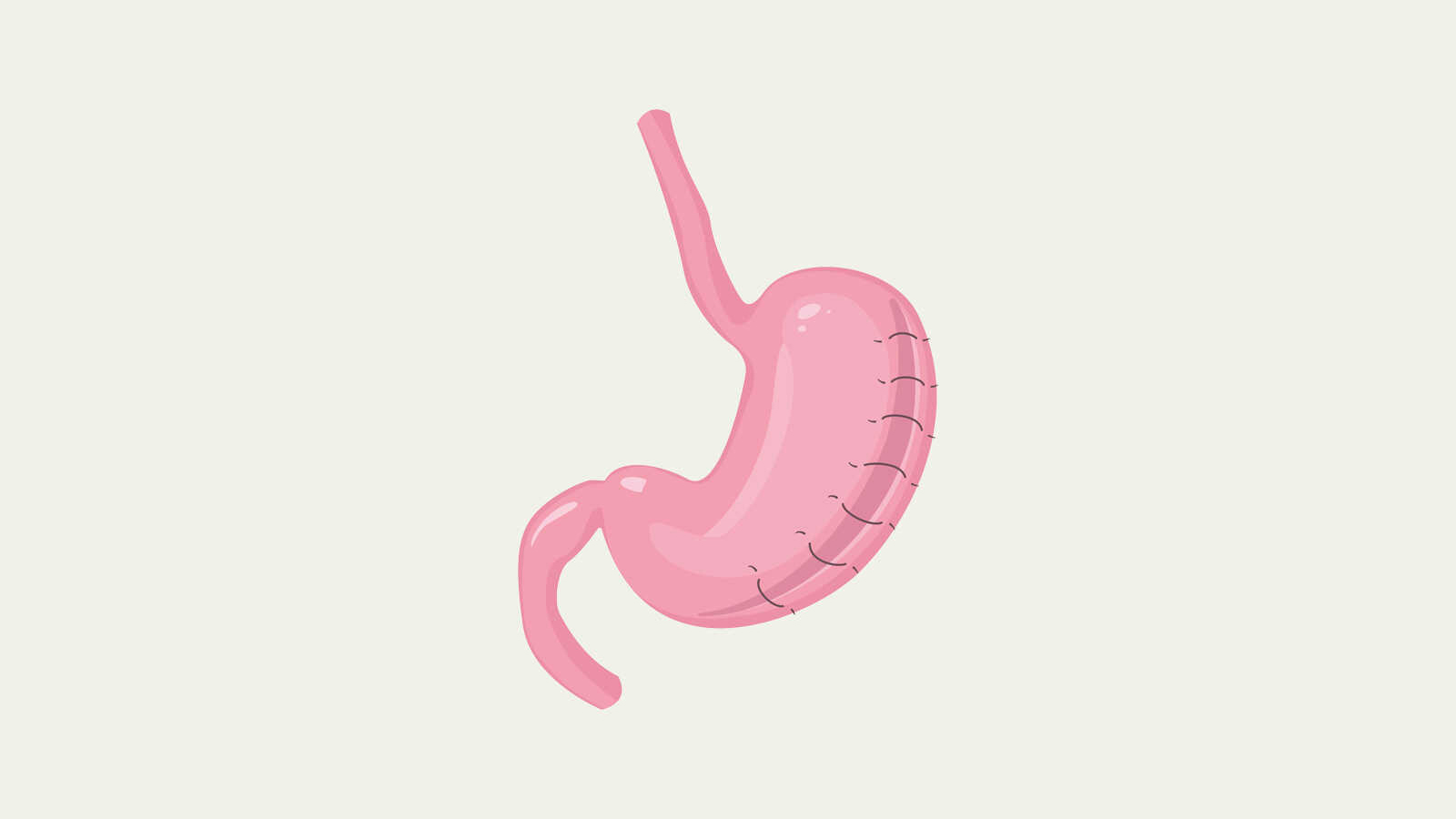 Gastric plication stomach illustration