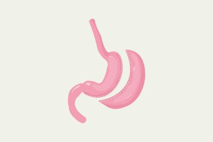 Gastric sleeve stomach illustration
