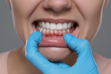 Close-up of patient’s teeth and gums being examined before gum contouring