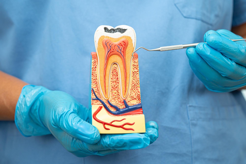Dentist holding a tooth model showing pulp and root canals for root canal treatment